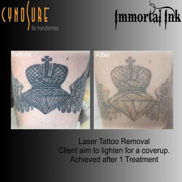 Laser Treatments and Laser Removal in Chelmsford, Essex. Immortal Ink Laser Treatments and Laser Removal in Chelmsford, Essex. Immortal Ink