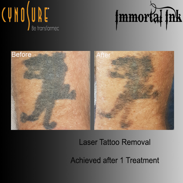 Laser Treatments and Laser Removal in Chelmsford, Essex. Immortal Ink Laser Treatments and Laser Removal in Chelmsford, Essex. Immortal Ink