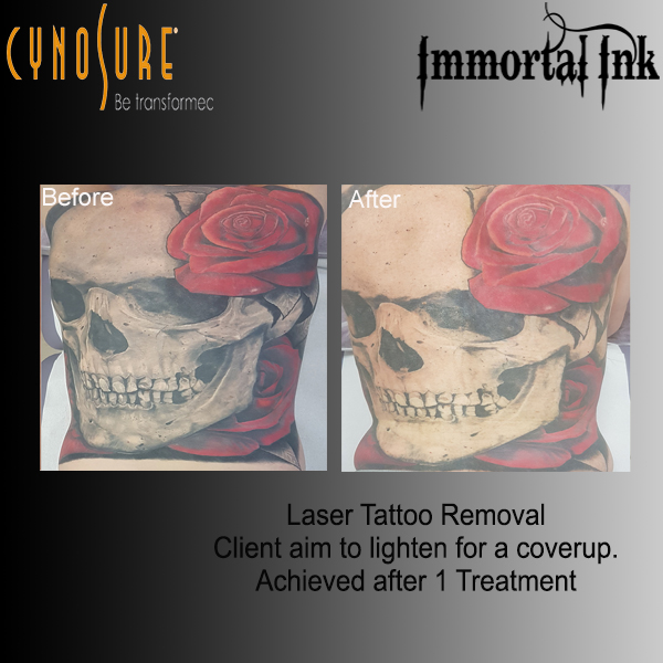 Laser Treatments and Laser Removal in Chelmsford, Essex. Immortal Ink