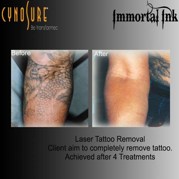 Laser Treatments and Laser Removal in Chelmsford, Essex. Immortal Ink Laser Treatments and Laser Removal in Chelmsford, Essex. Immortal Ink